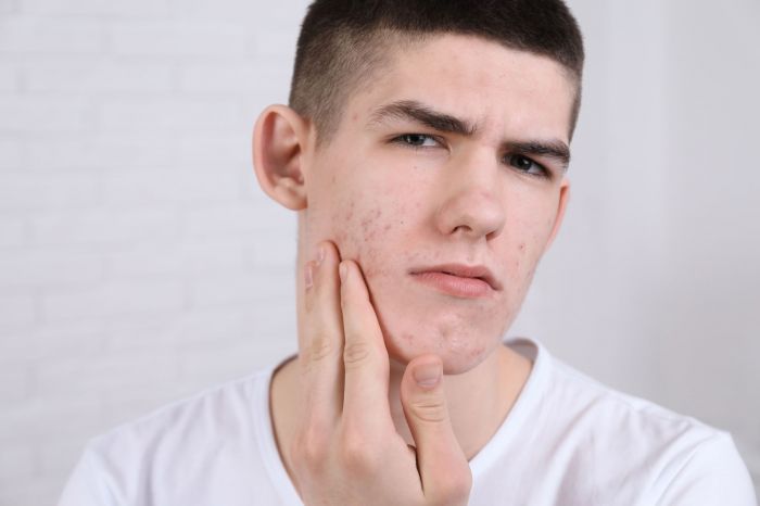 How To Treat Hormonal Acne Naturally