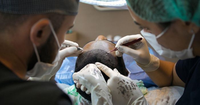 FUE vs. FUT: Choosing the Right Premium Hair Restoration Technique