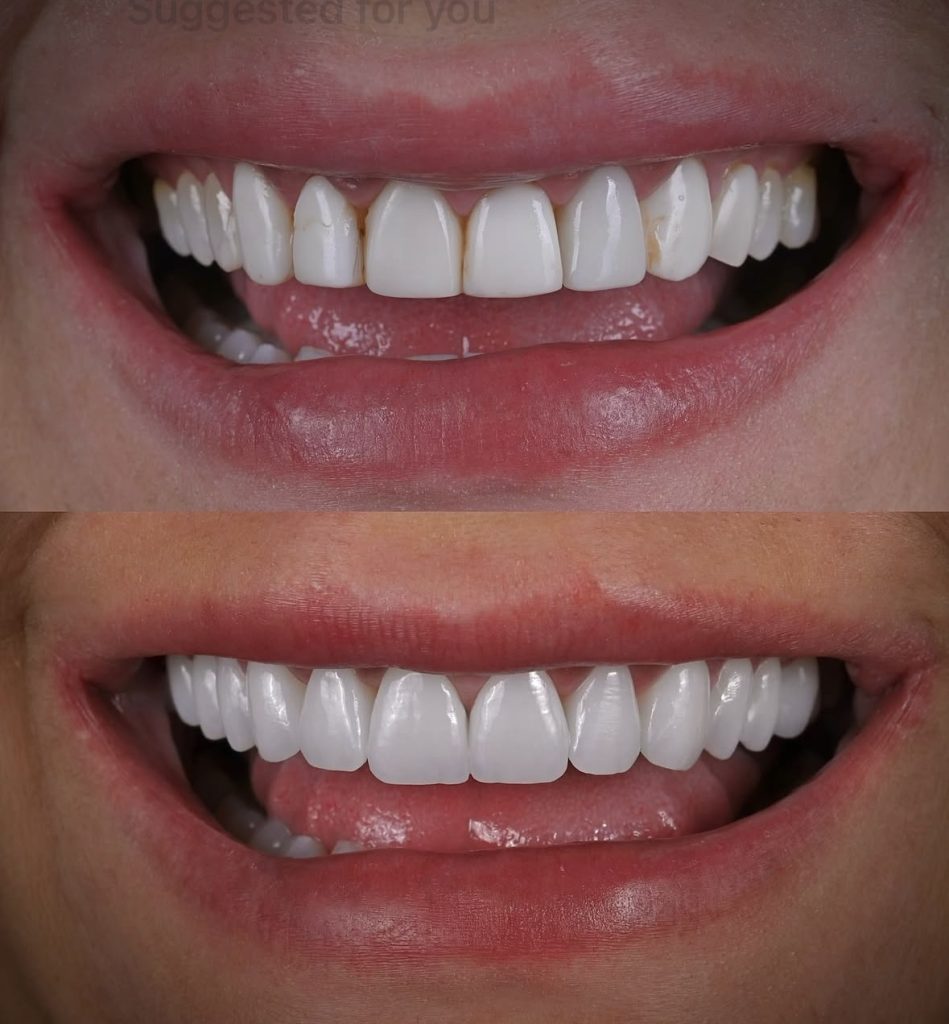 Before and after comparison of a smile transformation showcasing improved dental aesthetics and confidence.