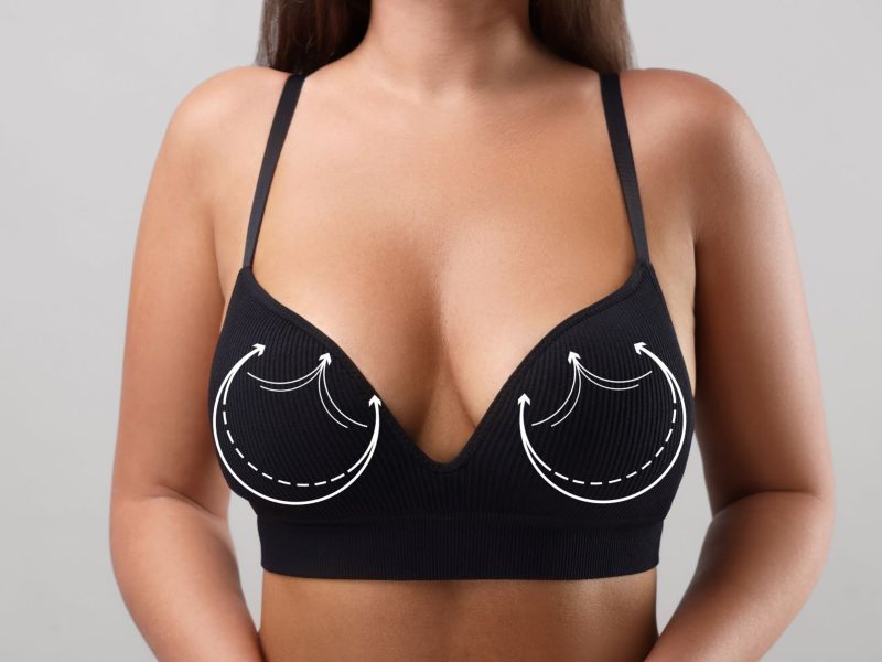 Illustration of a woman's torso in a black bra, highlighting the position of mesh implants with directional arrows.