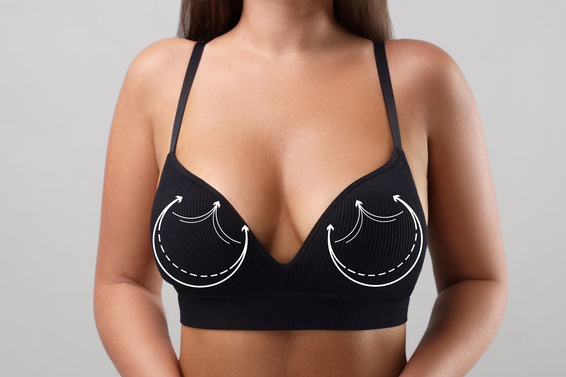 Illustration of a woman's torso in a black bra, highlighting the position of mesh implants with directional arrows.