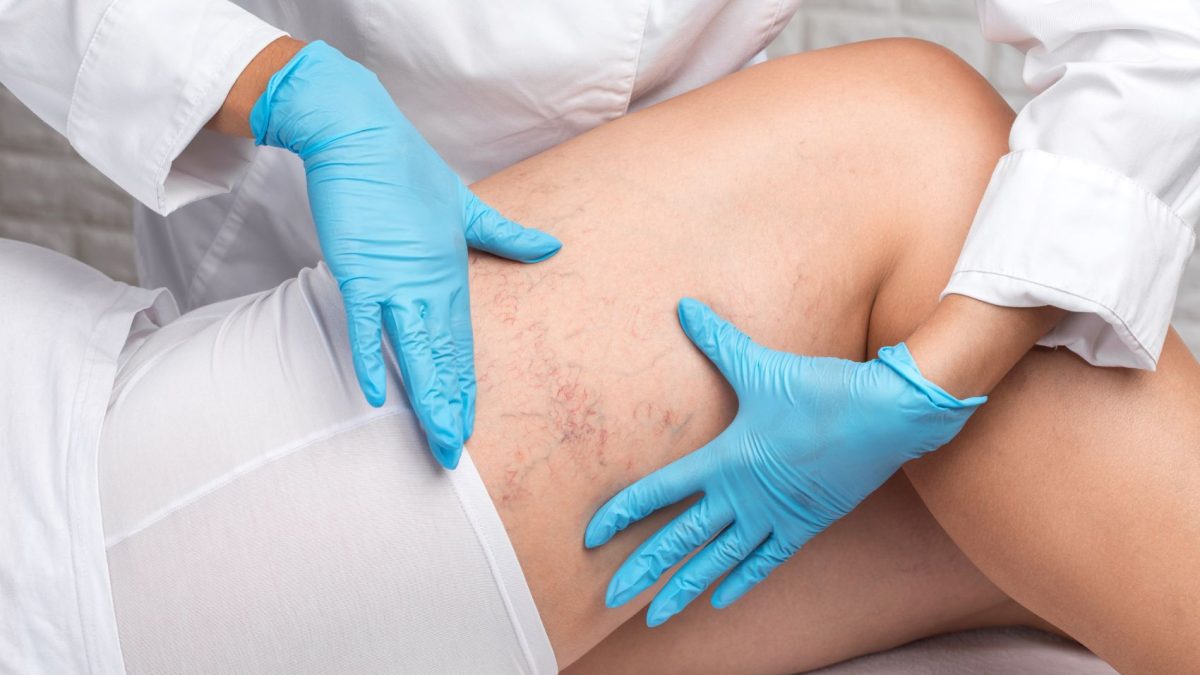 A healthcare professional examines leg veins, highlighting symptoms of vein issues for treatment consideration.