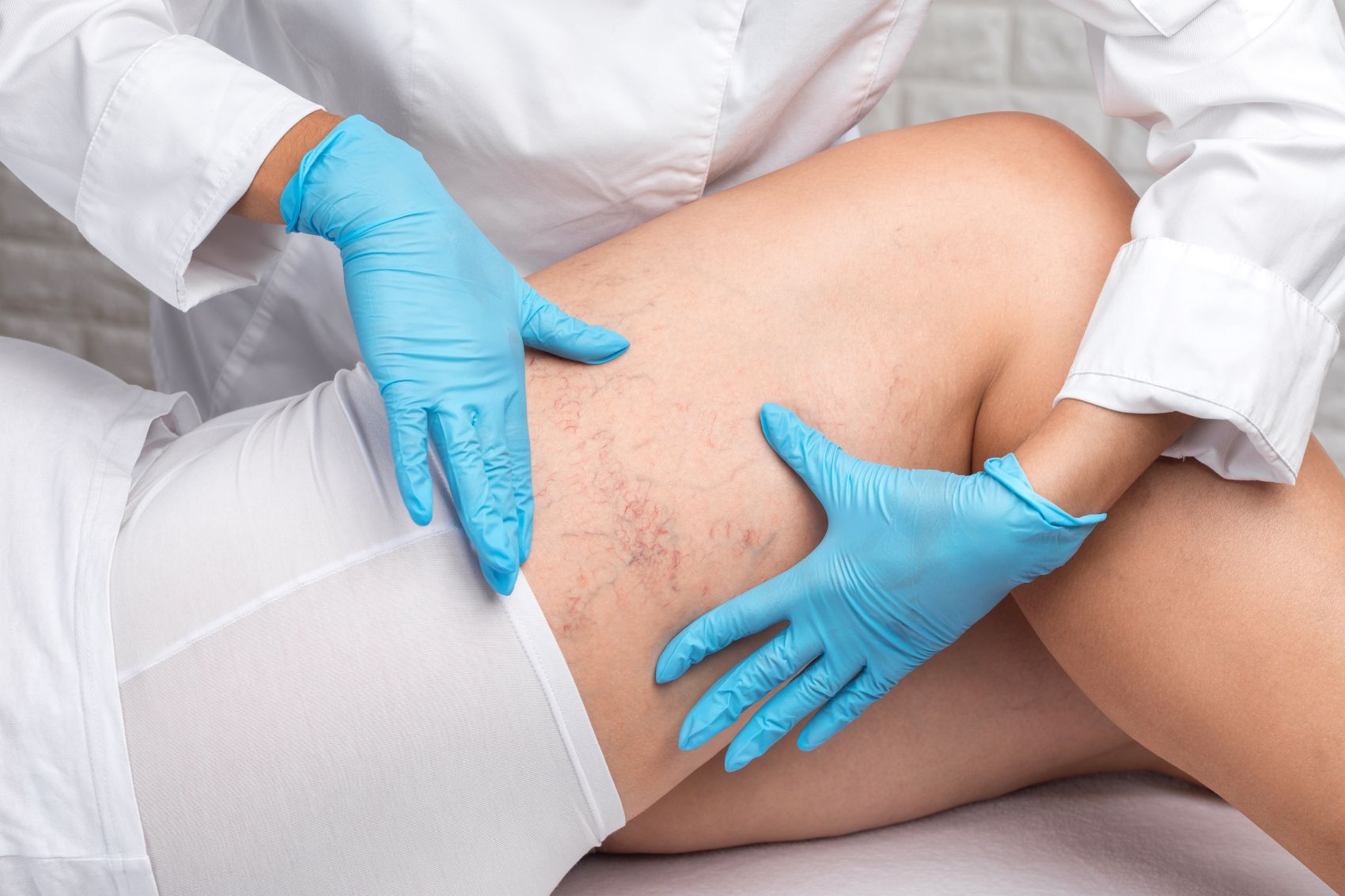 What to Know About Treating Vein Symptoms Before They Worsen