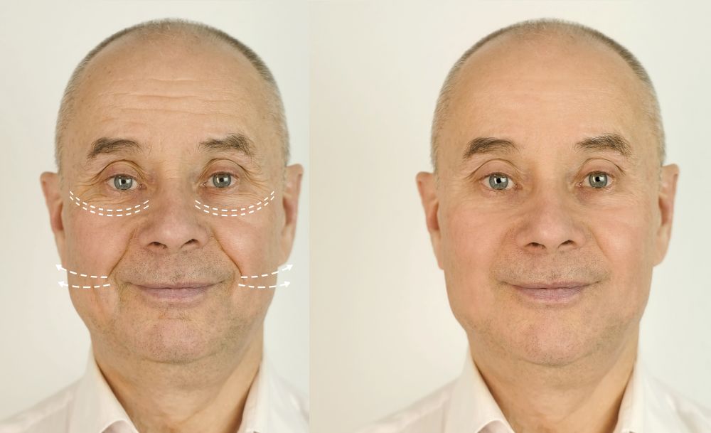 Illustrative stock comparison showing changes in facial contours following a facelift procedure.