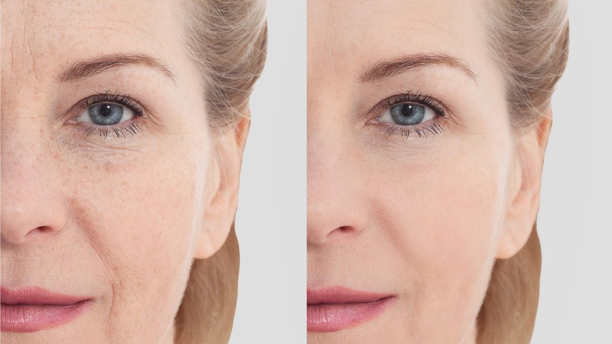 Before and after comparison of under-eye area showing reduced wrinkles and improved skin texture from microneedle eye patches.
