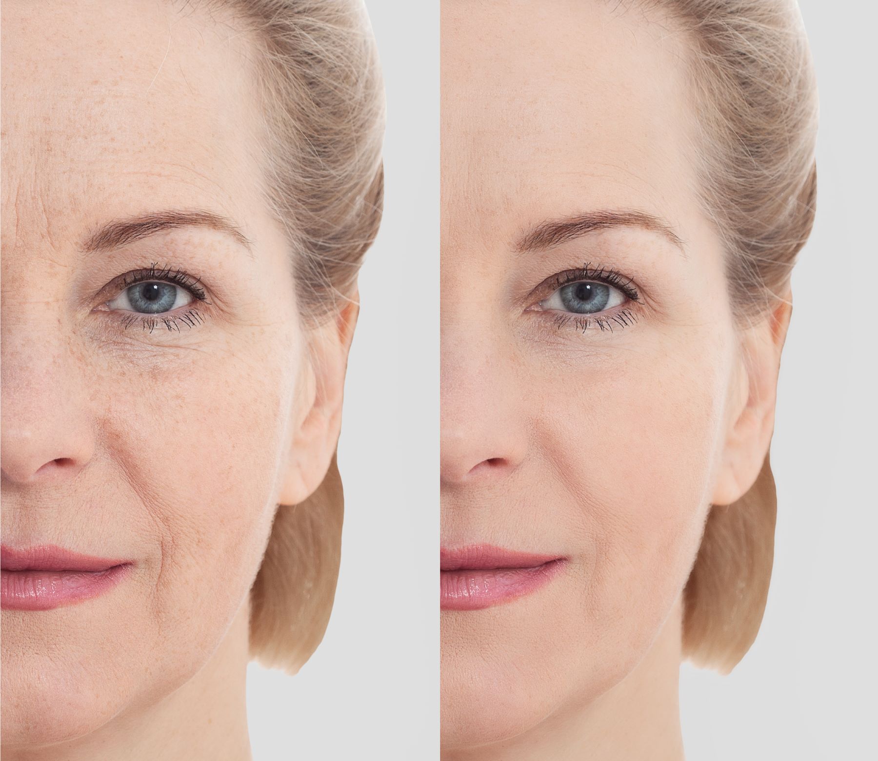 Before and after comparison of under-eye area showing reduced wrinkles and improved skin texture from microneedle eye patches.