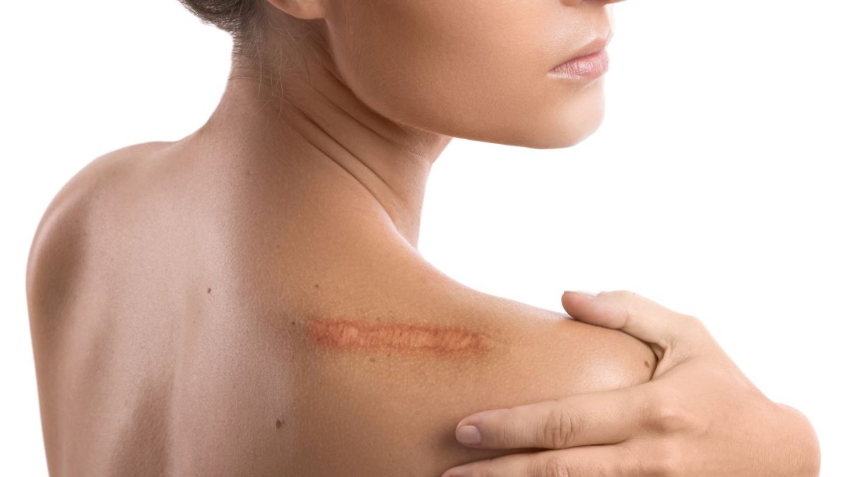 Woman holding her shoulder, revealing a visible scar along the skin, emphasizing the topic of healing creams for scars.