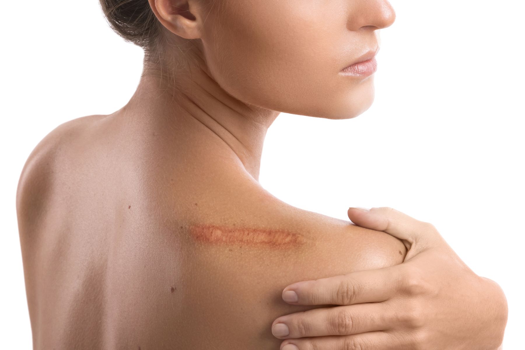 Woman holding her shoulder, revealing a visible scar along the skin, emphasizing the topic of healing creams for scars.